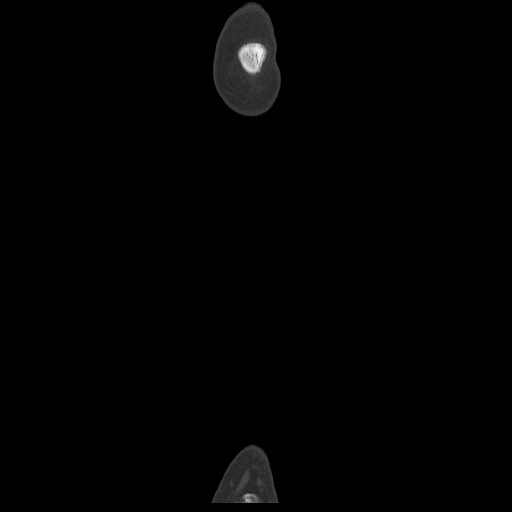 Normal CT tibia and fibula (Radiopaedia 51195-56848 Coronal non-contrast 11).jpg