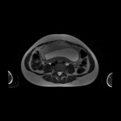 File:Normal MRI abdomen in pregnancy (Radiopaedia 88001-104541 Axial T2 41).jpg