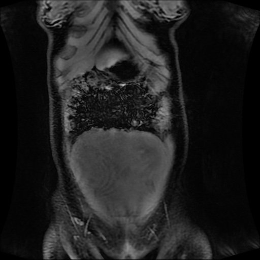 Normal MRI abdomen in pregnancy (Radiopaedia 88001-104541 M 35).jpg
