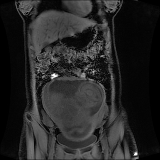 Normal MRI abdomen in pregnancy (Radiopaedia 88001-104541 M 46).jpg