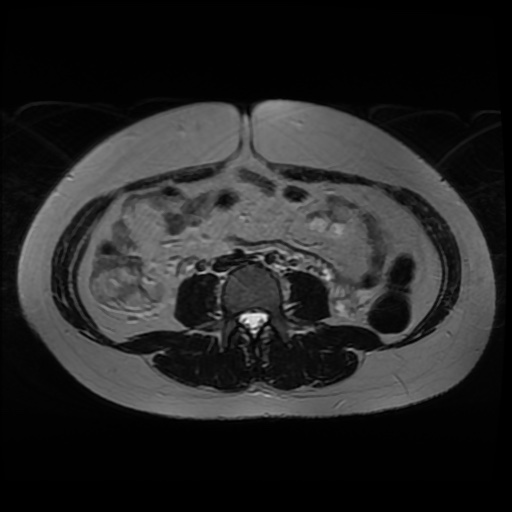 Normal MRI abdomen in pregnancy (Radiopaedia 88005-104548 Axial T2 1).jpg