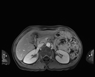 Normal adrenal glands MRI (Radiopaedia 82017-96004 M 35).jpg