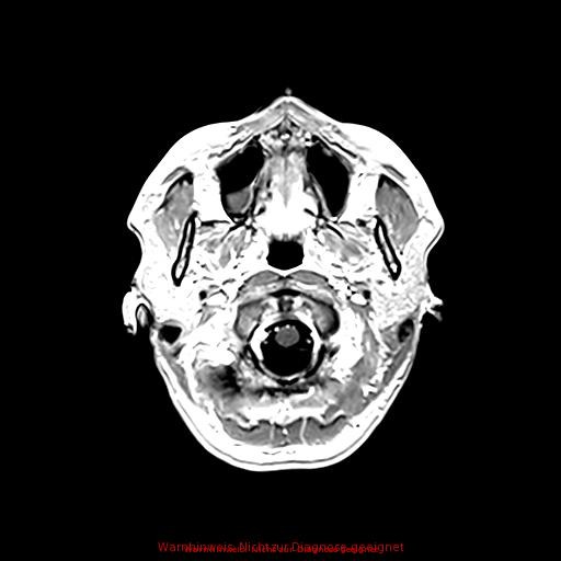 Normal adult brain MRI (non-enhanced and contrast-enhanced) (Radiopaedia 75262-86379 Axial T1 C+ 39).jpg