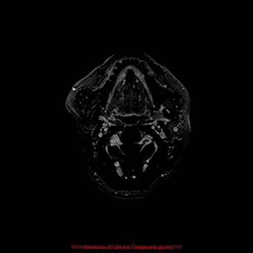 Normal adult brain MRI (non-enhanced and contrast-enhanced) (Radiopaedia 75262-86379 Axial T1 C+ 7).jpg