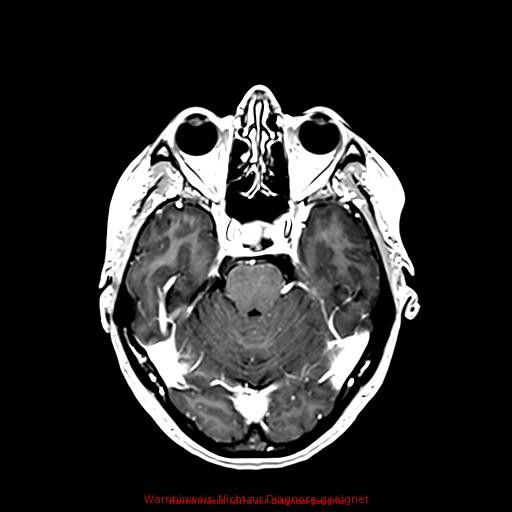 Normal adult brain MRI (non-enhanced and contrast-enhanced) (Radiopaedia 75262-86379 Axial T1 C+ 80).jpg