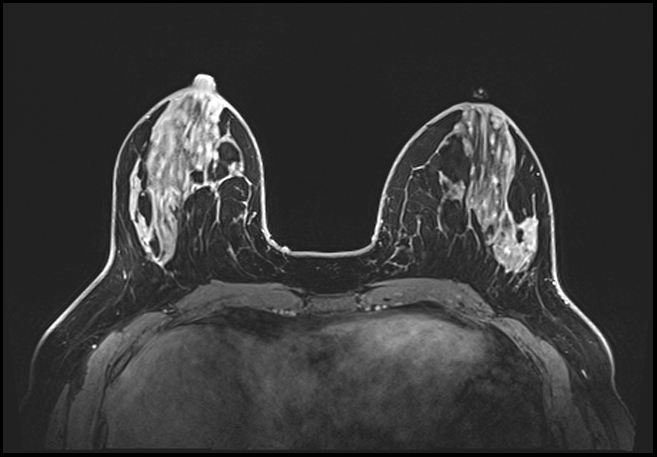 Normal breast MRI - dense breasts (Radiopaedia 80454-93850 C 84).jpg