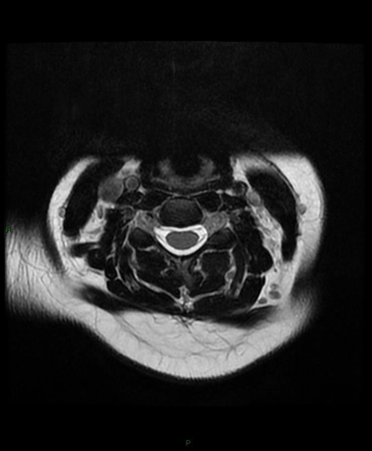 Normal cervical spine MRI (Radiopaedia 80146-93454 Axial T2 41).jpg