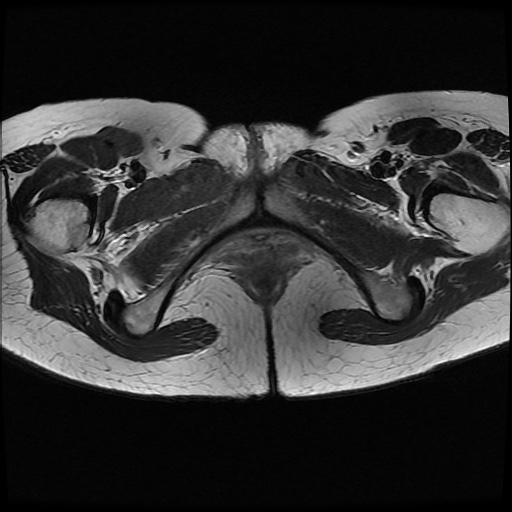 File:Normal female pelvis MRI (retroverted uterus) (Radiopaedia 61832-69933 Axial T2 28).jpg