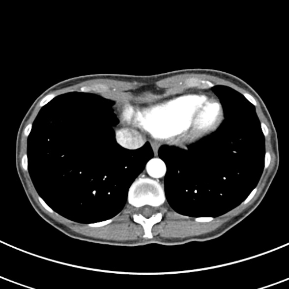File:Normal multiphase CT liver (Radiopaedia 38026-39996 B 3).jpg