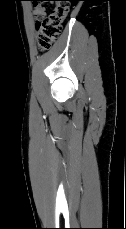 Normal pelvis CT angiogram (Radiopaedia 84966-100481 C 25).jpg