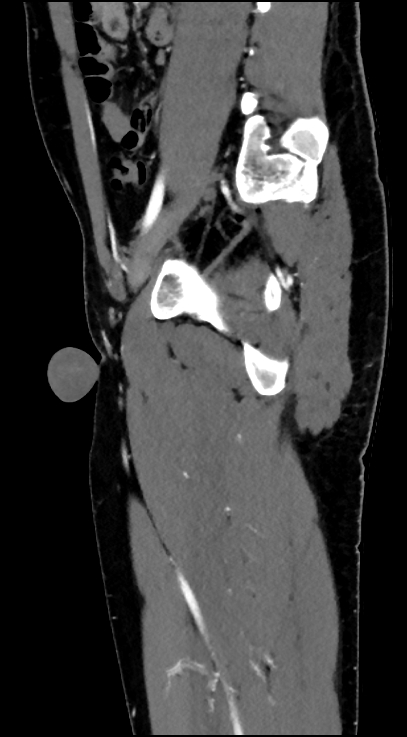 Normal pelvis CT angiogram (Radiopaedia 84966-100481 C 71).jpg