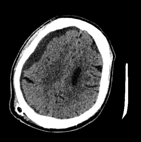 Normal pressure hydrocephalus (Radiopaedia 73685-84479 Axial non-contrast 57).jpg