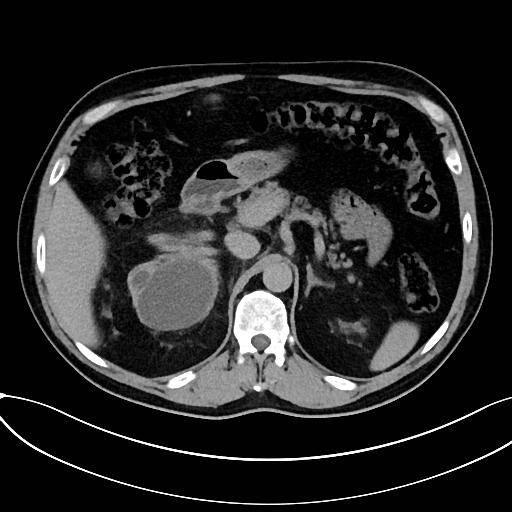 Obstructed upper pole ureter in a duplex kidney (Radiopaedia 54935-61221 Axial C+ delayed 3).jpg