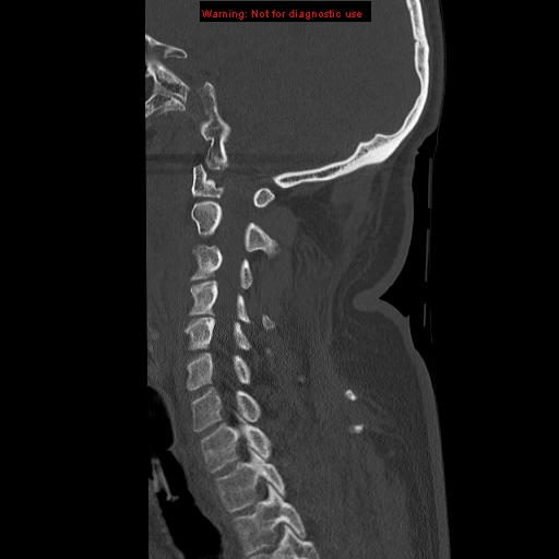 File:Occipital condyle fracture (Radiopaedia 18366-18208 Sagittal bone window 13).jpg