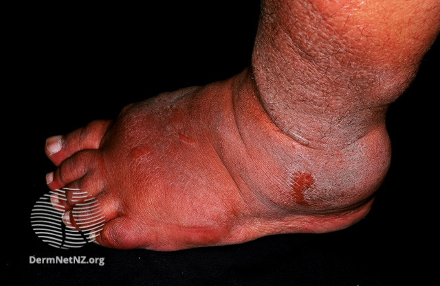 File:Pretibial myxoedema in Graves disease (DermNet NZ dermal-infiltrative-pretibial-myxoedema-06).jpg