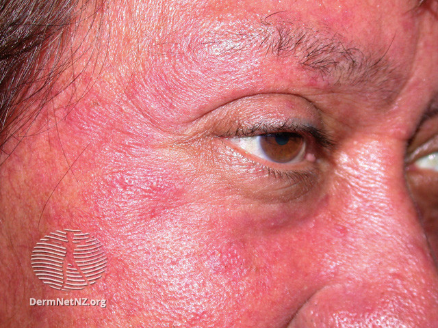 Rosacea (DermNet NZ acne-red-face-3626).jpg