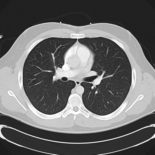 File:'Bovine' aortic arch (Radiopaedia 33554-34637 Axial lung window 28).png