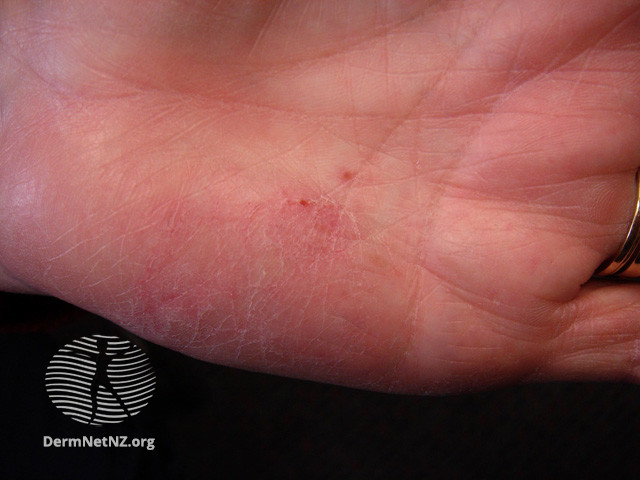 File:(DermNet NZ dermatitis-hand-dermatitis-2842).jpg