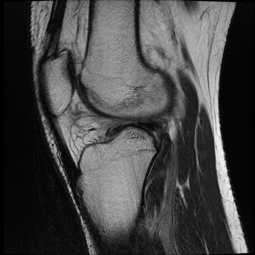File:ACL acute full thickness tear - deep lateral femoral sulcus sign (Radiopaedia 38594-40740 Sagittal T2 13).jpg