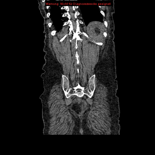 Abdominal aortic aneurysm- extremely large, ruptured (Radiopaedia 19882-19921 Coronal C+ arterial phase 92).jpg