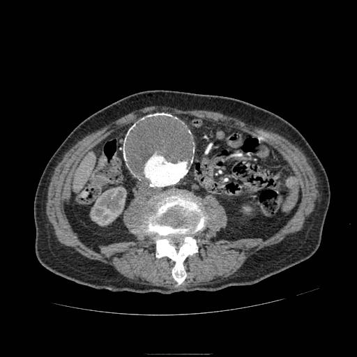 Abdominal aortic aneurysm (Radiopaedia 13341-13340 Axial C+ arterial phase 112).jpg