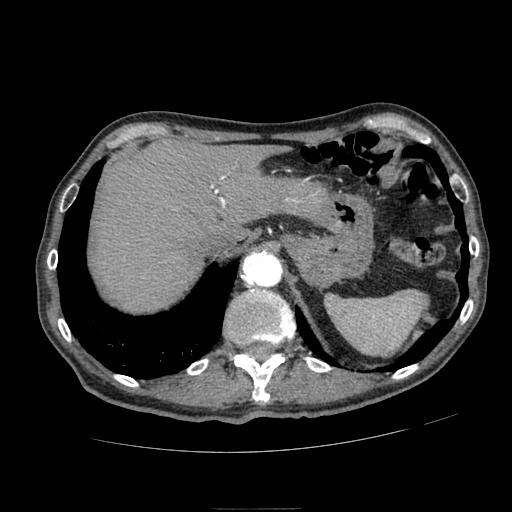 Abdominal aortic aneurysm (Radiopaedia 13341-13340 Axial C+ arterial phase 29).jpg