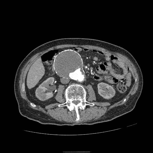 Abdominal aortic aneurysm (Radiopaedia 13341-13340 Axial C+ arterial phase 96).jpg