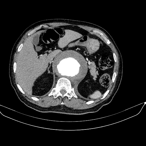 File:Abdominal aortic aneurysm (Radiopaedia 67117-76452 Axial C+ arterial phase 33).jpg