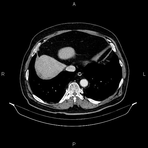 Abdominal aortic aneurysm (Radiopaedia 83094-97462 Axial renal cortical phase 61).jpg
