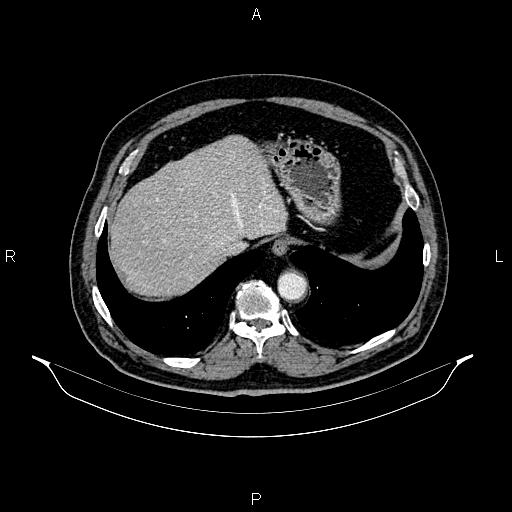Abdominal aortic aneurysm (Radiopaedia 83094-97462 Axial renal cortical phase 66).jpg