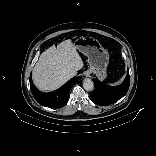Abdominal aortic aneurysm (Radiopaedia 83094-97462 Axial renal excretory phase 21).jpg