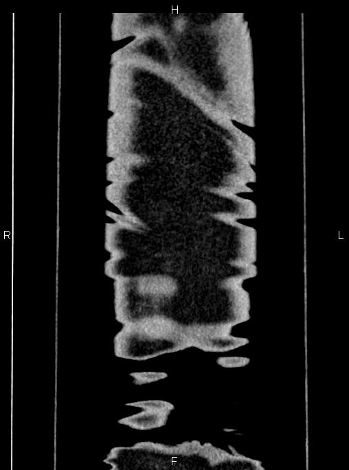 Abdominal aortic aneurysm (Radiopaedia 83094-97462 Coronal renal cortical phase 96).jpg