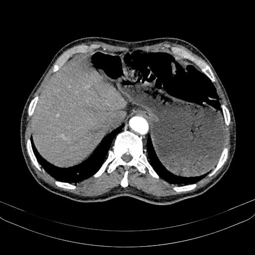 Abdominal aortic aneurysm (Radiopaedia 83581-98689 Axial C+ arterial phase 24).jpg