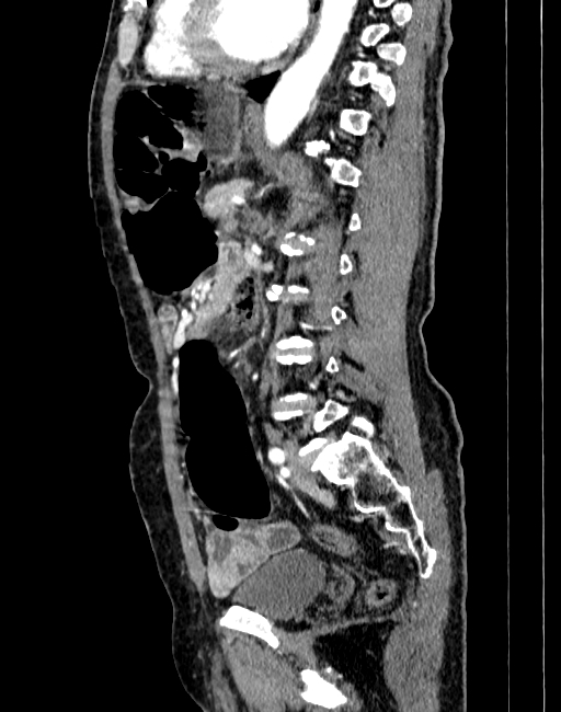 Abdominal aortic aneurysm (Radiopaedia 83581-98689 Sagittal C+ arterial phase 64).jpg