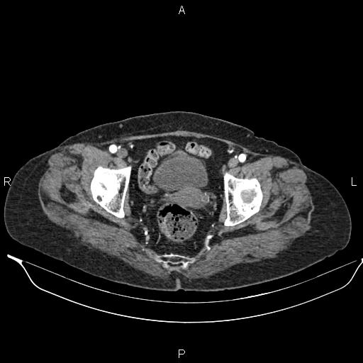 File:Abdominal aortic aneurysm (Radiopaedia 85063-100606 Axial C+ arterial phase 61).jpg