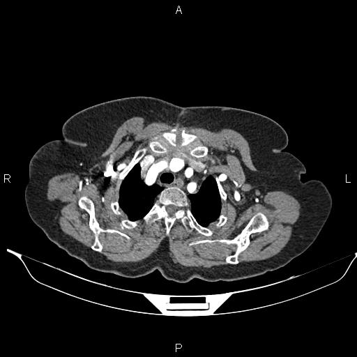 File:Abdominal aortic aneurysm (Radiopaedia 85063-100606 Axial C+ arterial phase 8).jpg