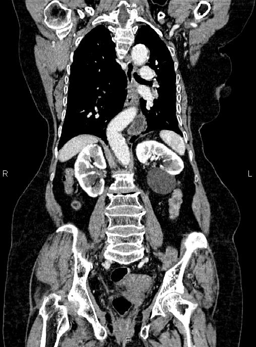 Abdominal aortic aneurysm (Radiopaedia 85063-100606 Coronal C+ arterial phase 37).jpg