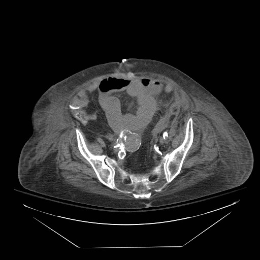 File:Abdominal aortic aneurysm - impending rupture (Radiopaedia 19233-19247 Axial non-contrast 130).jpg