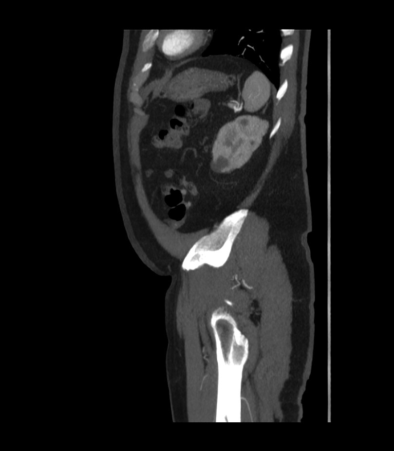 Abdominal aortic aneurysm with thrombus fissuration (Radiopaedia 46218-50618 Sagittal C+ arterial phase 50).jpg