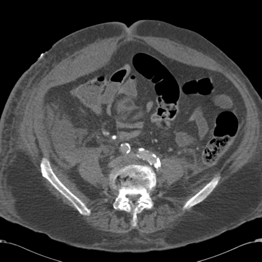 Abdominal hematoma (Radiopaedia 33614-34715 Axial C+ portal venous phase 82).png