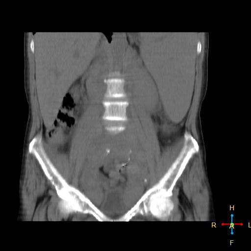 File:Abdominal lymphoma (Radiopaedia 23085-23115 Coronal non-contrast 13).jpg