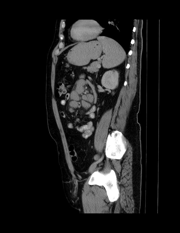 Abdominal lymphoma - with sandwich sign (Radiopaedia 53486-59492 Sagittal C+ portal venous phase 25).jpg