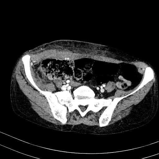 Abdominal wall hematoma with active bleeding (Radiopaedia 83915-99117 Axial renal cortical phase 96).jpg