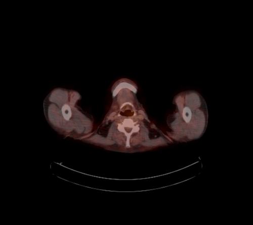 Abdominal wall metastasis from colorectal carcinoma (Radiopaedia 31016-31719 C 136).jpg