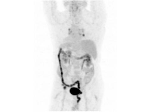 File:Abdominal wall metastasis from colorectal carcinoma (Radiopaedia 31016-31719 Rotational MIP 15).jpg