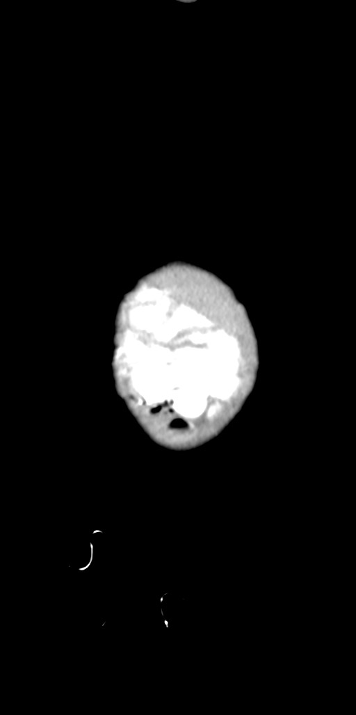 Abdominopelvic rhabdomyosarcoma (Radiopaedia 78356-90984 Sagittal C+ portal venous phase 98).jpg