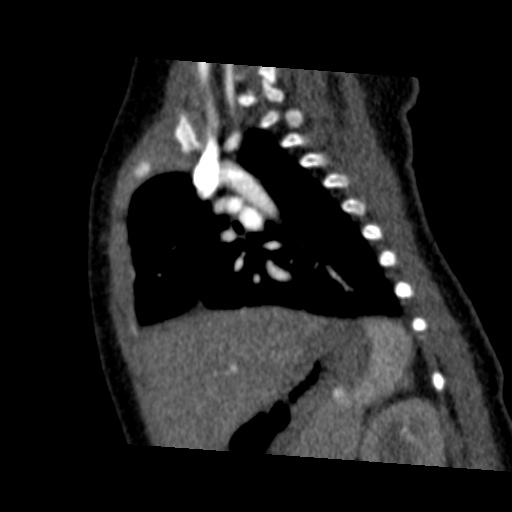 File:Aberrant left pulmonary artery (pulmonary sling) (Radiopaedia 42323-45435 Sagittal C+ arterial phase 36).jpg