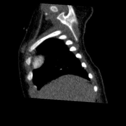 Aberrant left pulmonary artery (pulmonary sling) (Radiopaedia 42323-45435 Sagittal C+ arterial phase 7).jpg