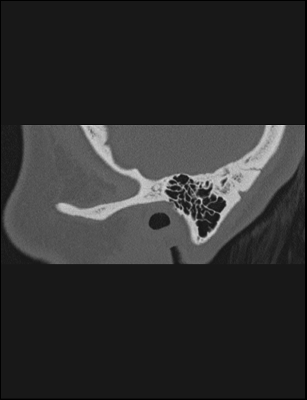 Aberrant right internal carotid artery (Radiopaedia 65191-74198 Sagittal non-contrast 16).jpg