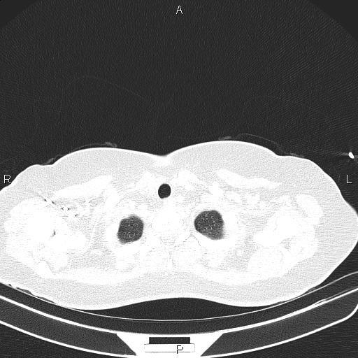 Aberrant right subclavian artery (Radiopaedia 87334-103629 Axial lung window 9).jpg